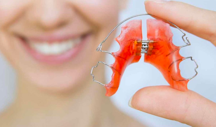 Palatal expanders Treatment