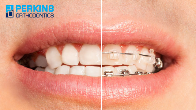Learn more about how much braces cost.