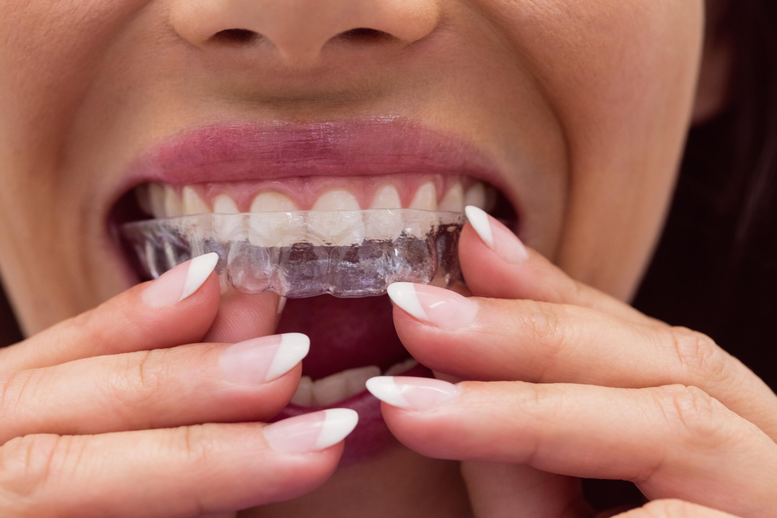 retainers after baces benbrook tx